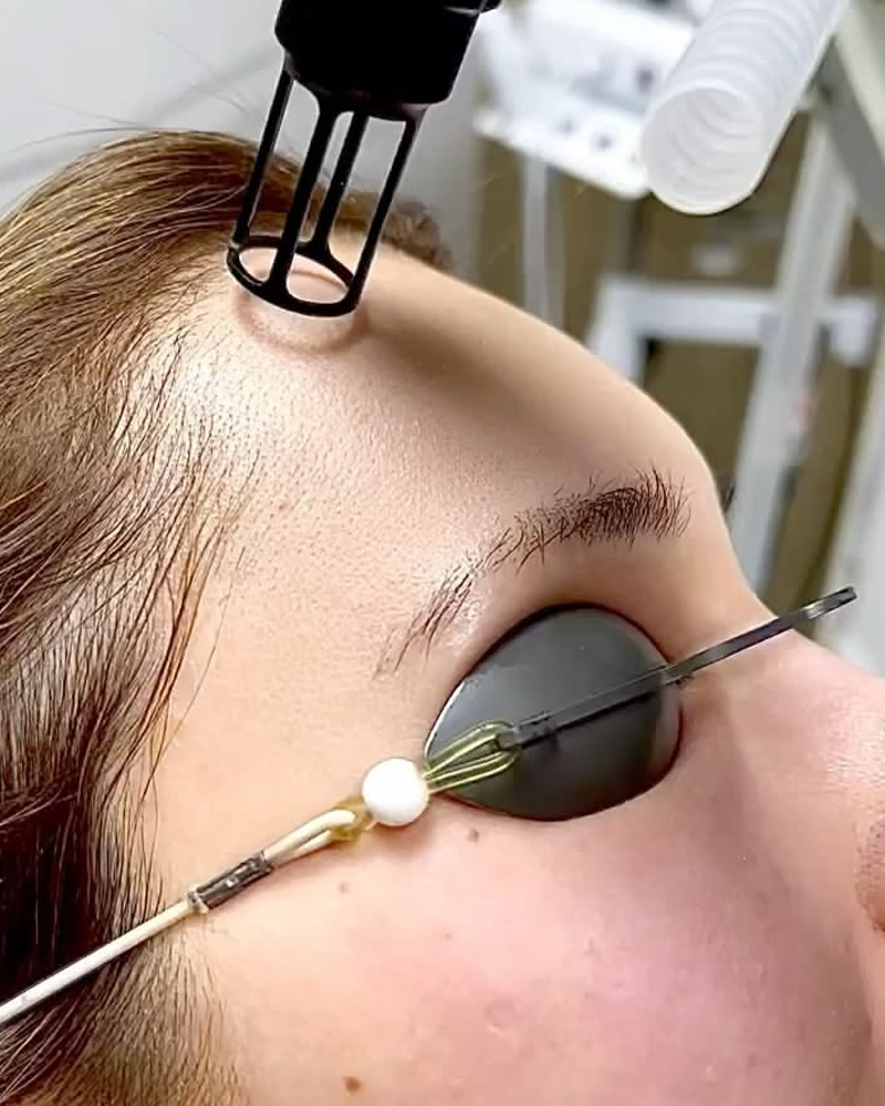 Laser Treatment for Acne Scars