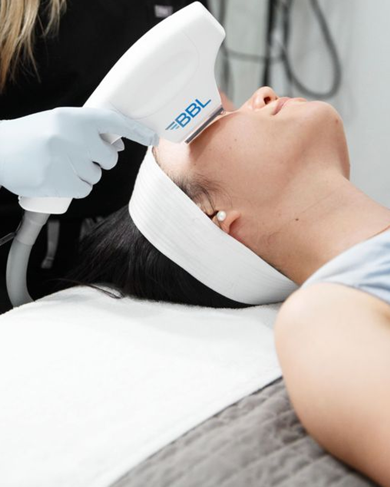 BBL Photofacial