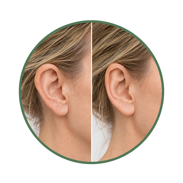 Ear Shape & Cartilage