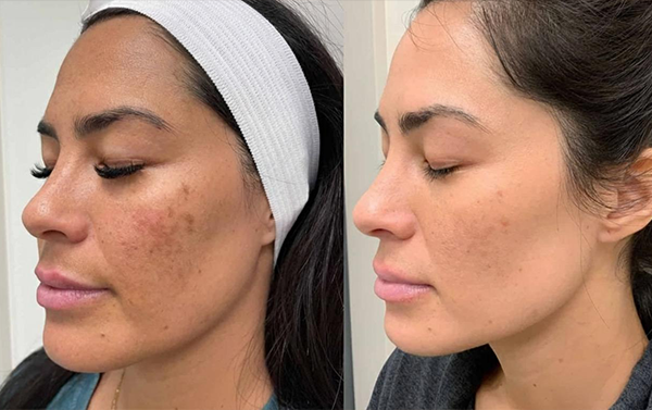 Chemical Peels
