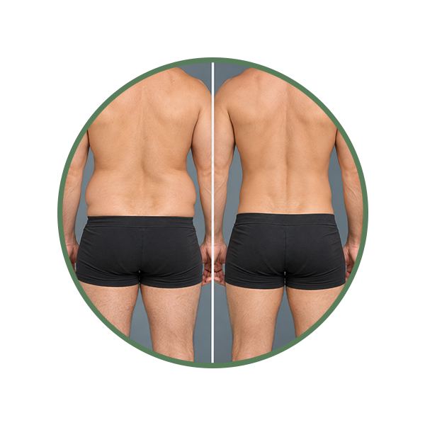 Flanks & Love Handles