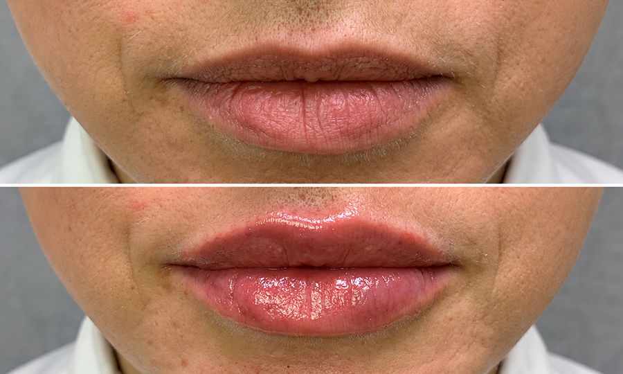 Fillers