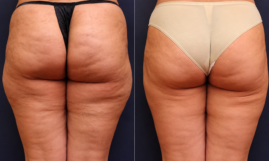 Fat Transfer