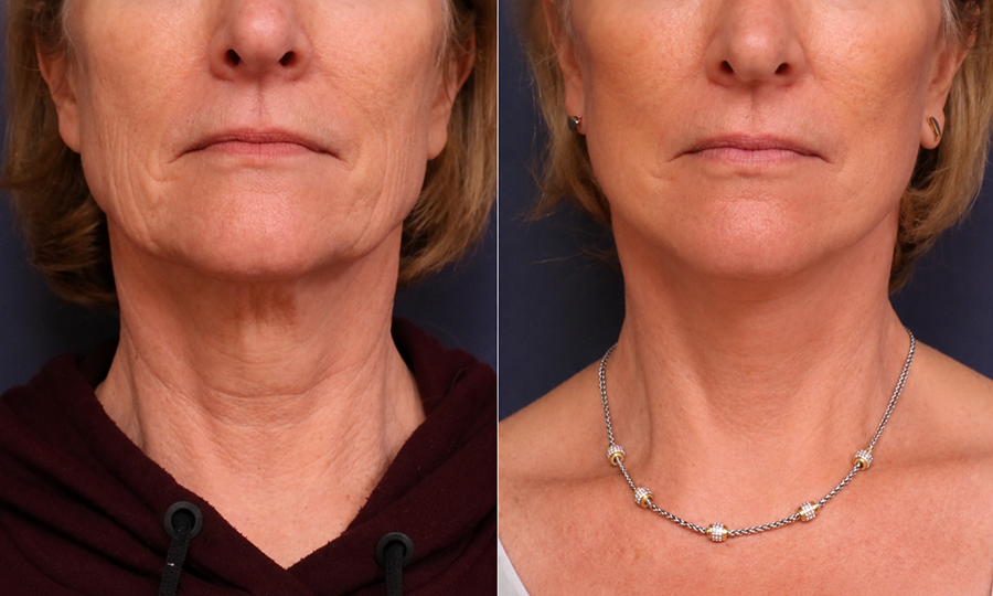 Neck Lift