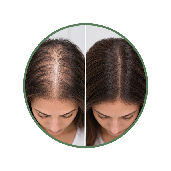Thinning Hair