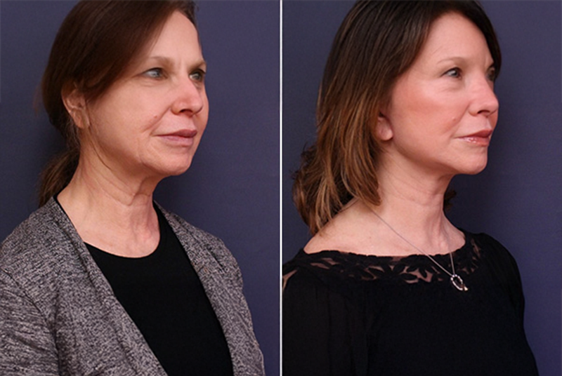 Fat Transfer to Face