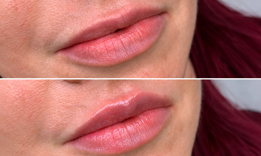 Juvederm
