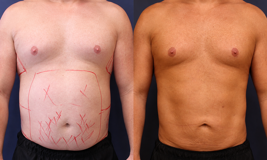 SmartLipo for Men