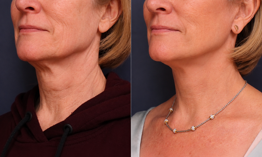 Neck Lift
