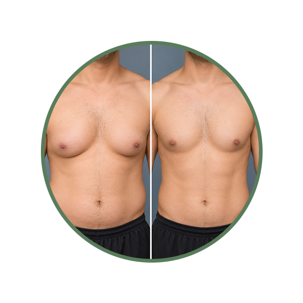 Softer Chest Tissue