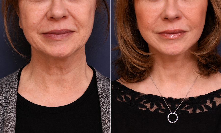 Facelift Surgery
