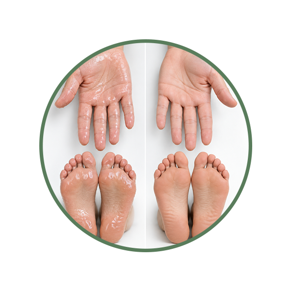 Sweaty Hands and Feet