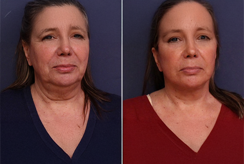 O-Shot