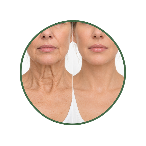 Loose Neck Skin
