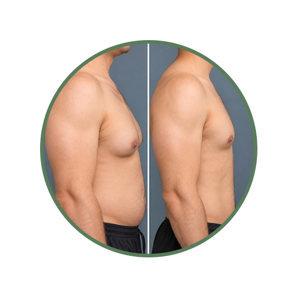 Male Chest Contouring