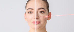 Laser Treatment for Acne Scars Near Me in Langhorne, Philadelphia, PA