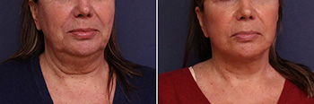 Necklift Before and After Treatment Results at Center for SmartLipo & Plastic Surgery in Langhorne, and Philadelphia, PA
