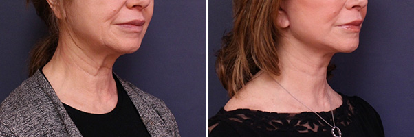 Necklift Before and After Treatment Results at Center for SmartLipo & Plastic Surgery in Langhorne, and Philadelphia, PA