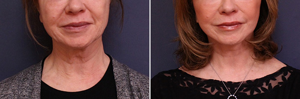 Necklift Before and After Treatment Results at Center for SmartLipo & Plastic Surgery in Langhorne, and Philadelphia, PA