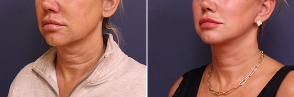 Facelift/Necklift Before and After Treatment Results at Center for SmartLipo & Plastic Surgery in Langhorne, and Philadelphia, PA