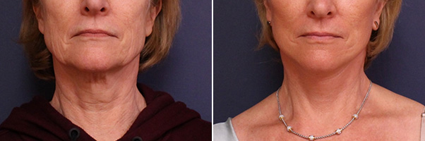 Facelift/Necklift Before and After Treatment Results at Center for SmartLipo & Plastic Surgery in Langhorne, and Philadelphia, PA