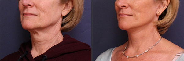 Facelift/Necklift Before and After Treatment Results at Center for SmartLipo & Plastic Surgery in Langhorne, and Philadelphia, PA