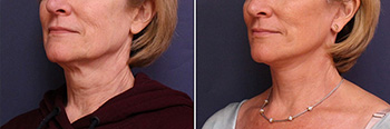Facelift/Necklift Before and After Treatment Results at Center for SmartLipo & Plastic Surgery in Langhorne, and Philadelphia, PA
